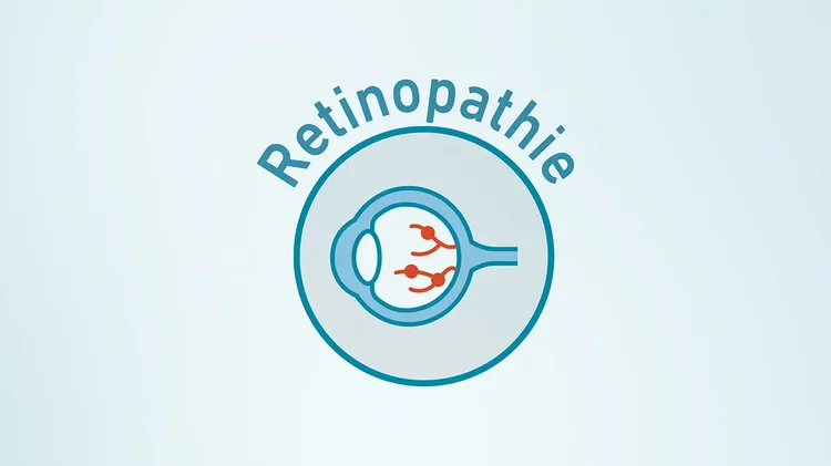 Grafik zeigt Auge mit Netzhautschäden durch Retinopathie.