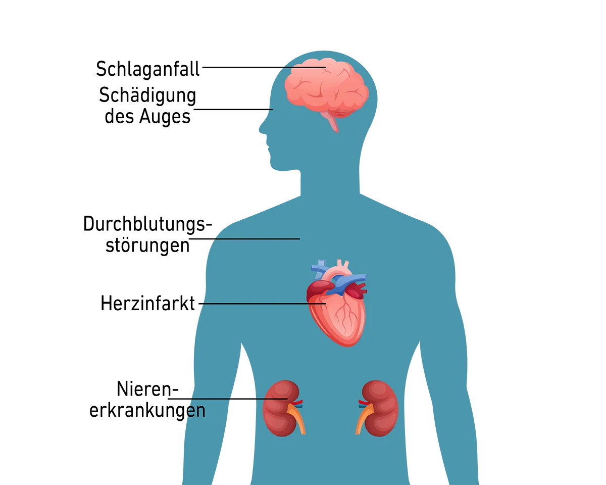 Grafik zeigt Körper mit Markierungen an Gehirn, Herz und Nieren bei Bluthochdruck.