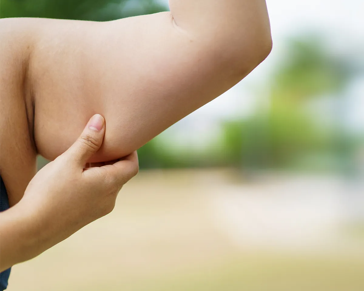 Person greift erschlaffte Haut am Oberarm mit den Fingern.
